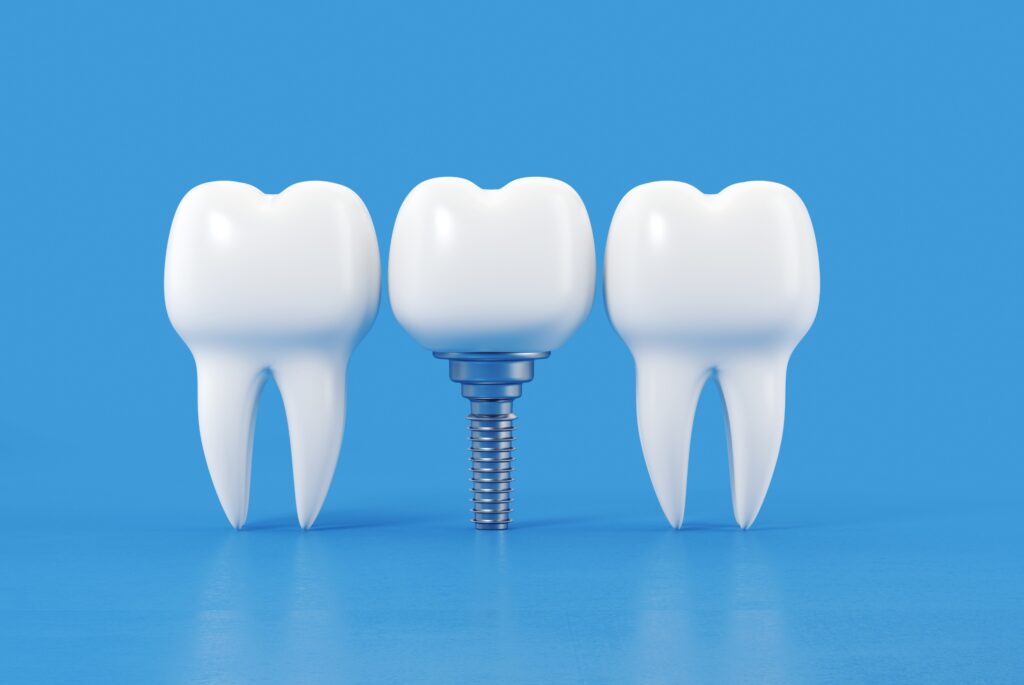 implantología-santiagodecompostela-ideodental