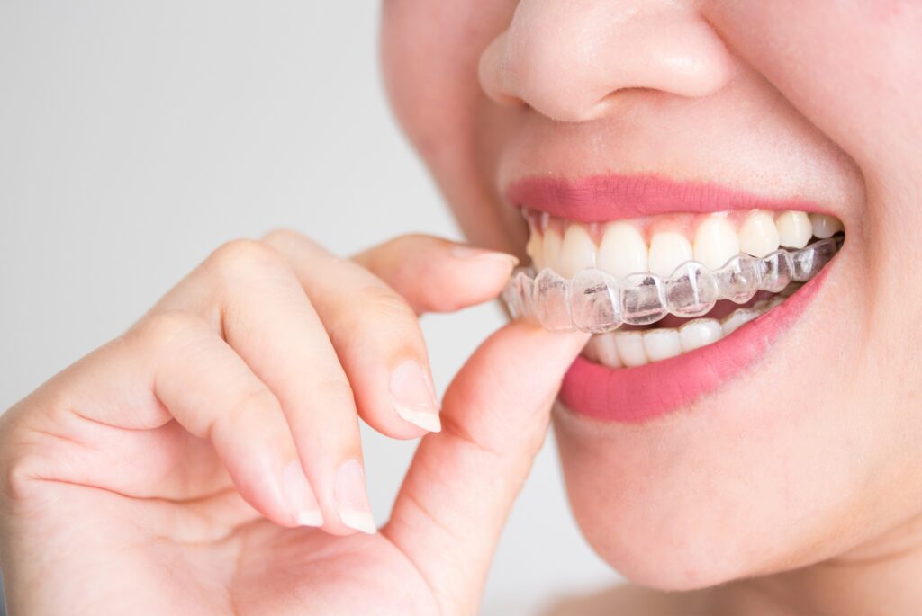 invisalign-ideodental-santiago-de-compostela.jpg
