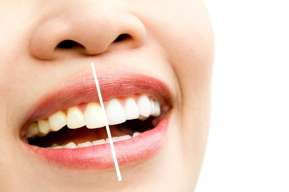 Detalle del instrumental utilizado para garantizar un blanqueamiento dental seguro y eficaz en nuestra clínica